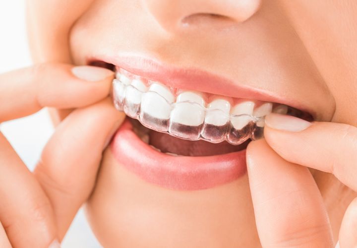 Unsichtbare Zahnspange für unauffällige Zahnkorrektur - Aligner